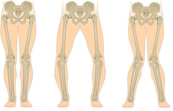 Tipos de osteoartrite