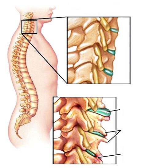 Columna vertebral saudable e osteocondrose danada