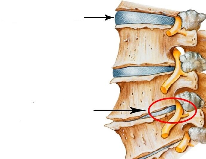 Disco danado e o nervio con osteocondrose cervical