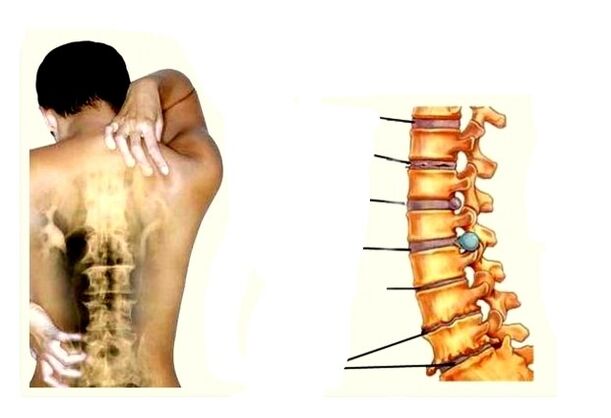 Etapas de desenvolvemento da osteocondrose