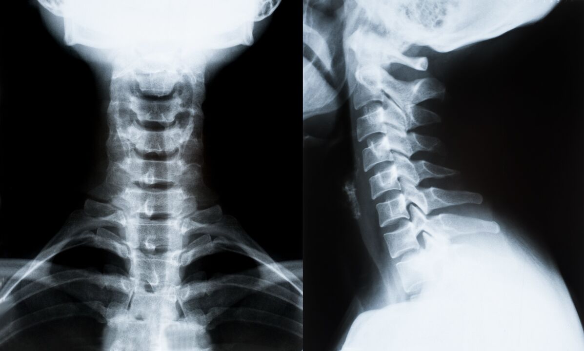 Osteocondrose cervical en raios X