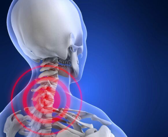 Osteocondrose da columna cervical