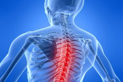 Compresión da medula espiñal na osteocondrose torácica